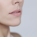 Cirurgia Plástica Facial - Mentoplastia (Cirurgia do Queixo)